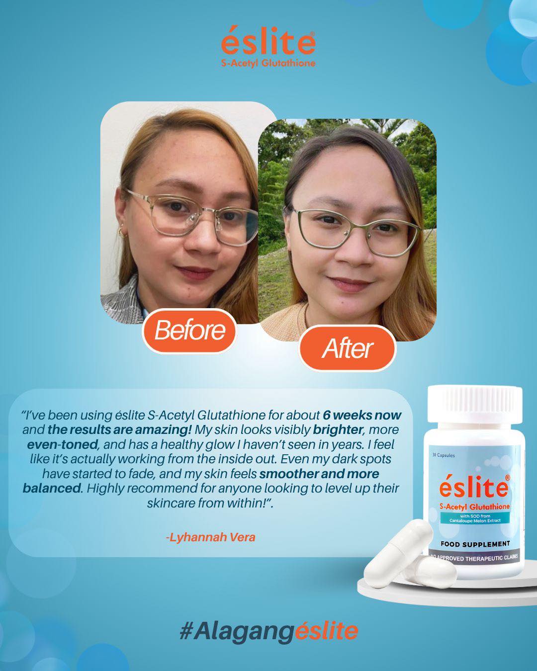s acetyl glutathione review Eslite S-Acetyl (@eslitesacetylglutathione) • Facebook prohealth bpc 157 reviews تونر اثار حب الشباب Size:50 caps