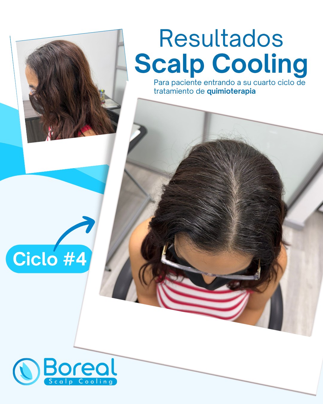 Boreal Scalp Cooling PR