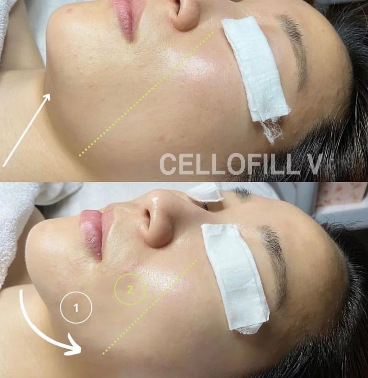 Slim your face V라인만 살리는게 아니예요~... - Cellofillofficial