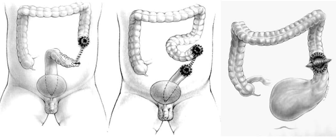 Drank - Why it is crucial to do the correct colostomy in patients with ...