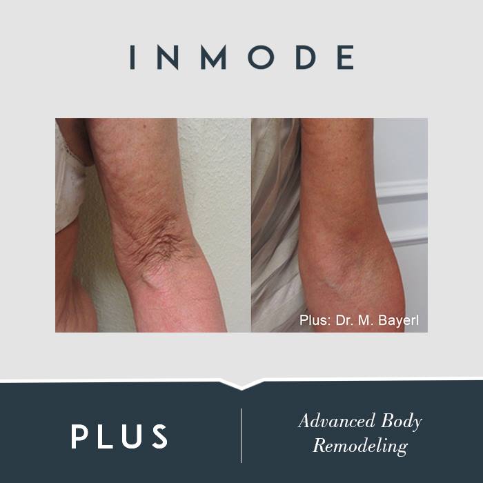 Radiance Medspa - The #InMode #FormaPlus works great on...