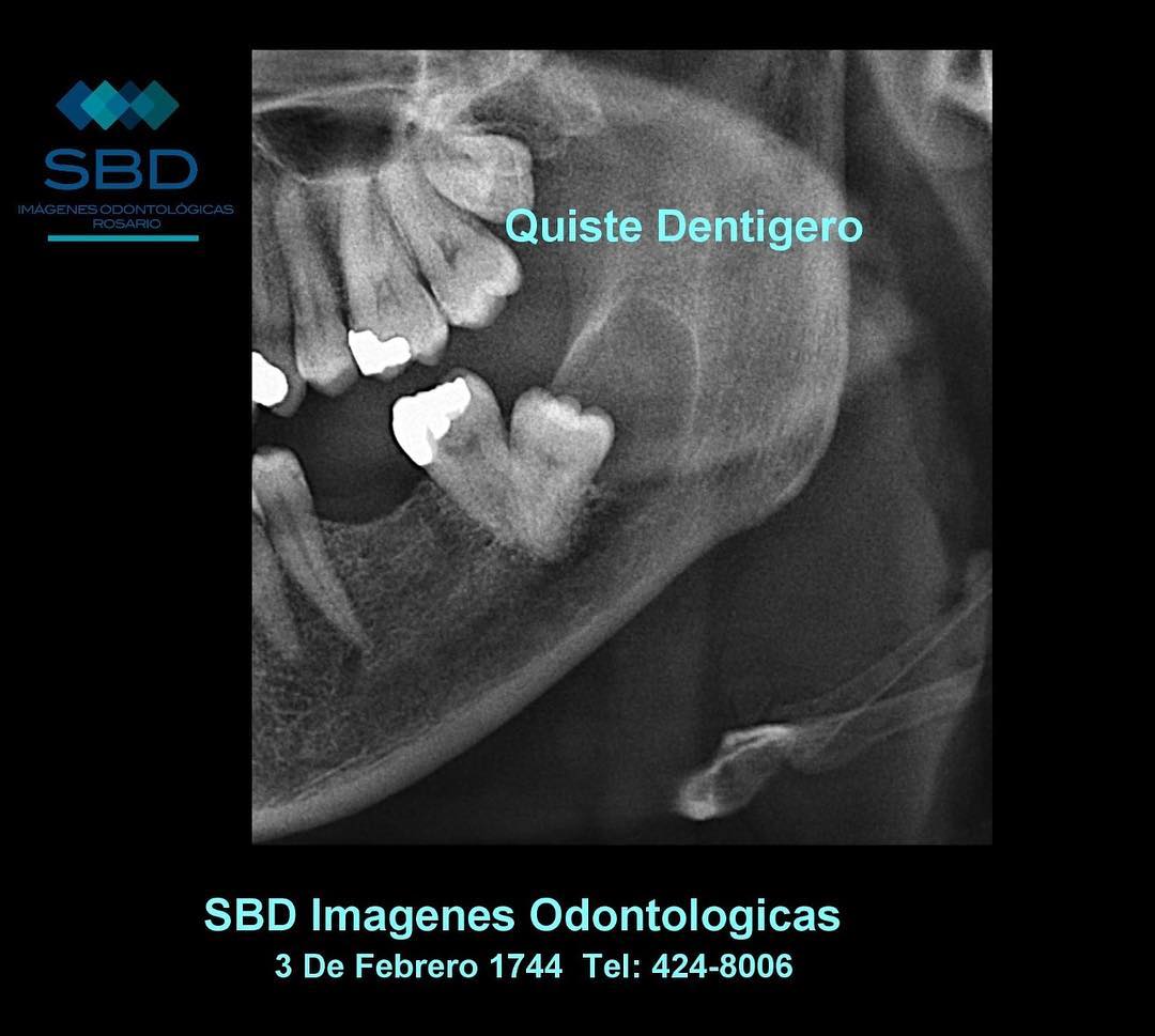 SBD - Un quiste dentigero es un quiste que se forma alrededor de la ...