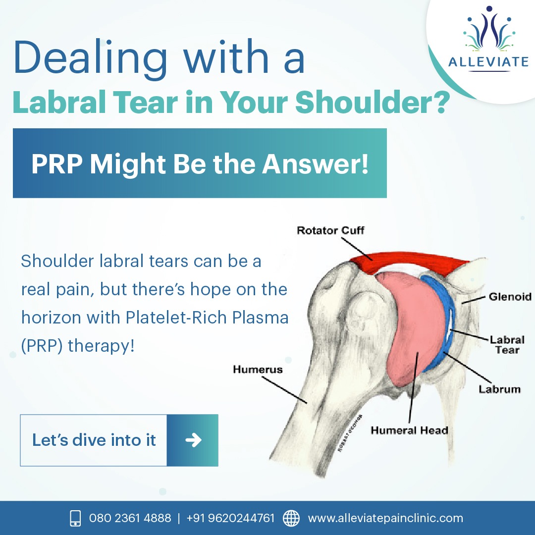bpc 157 shoulder labrum Failed Rotator Cuff Repair: Revision Options Shoulder Pain in Newport Beach,
