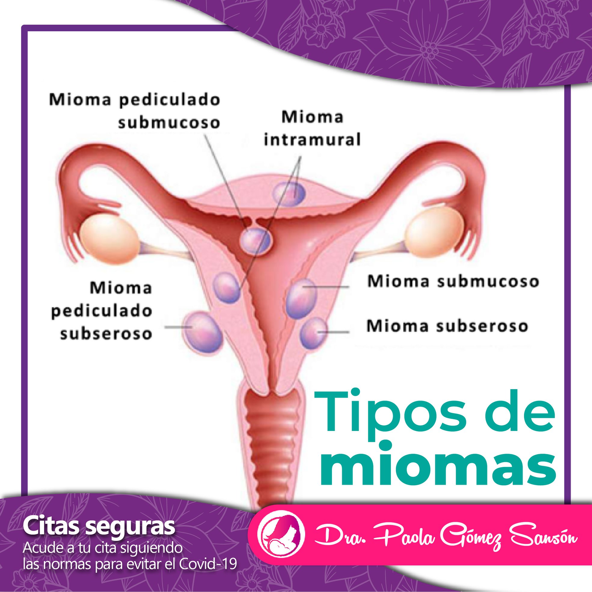 tipos-de-miomas-uterinos-mioma-todo-sobre-los-miomas-uterinos-el