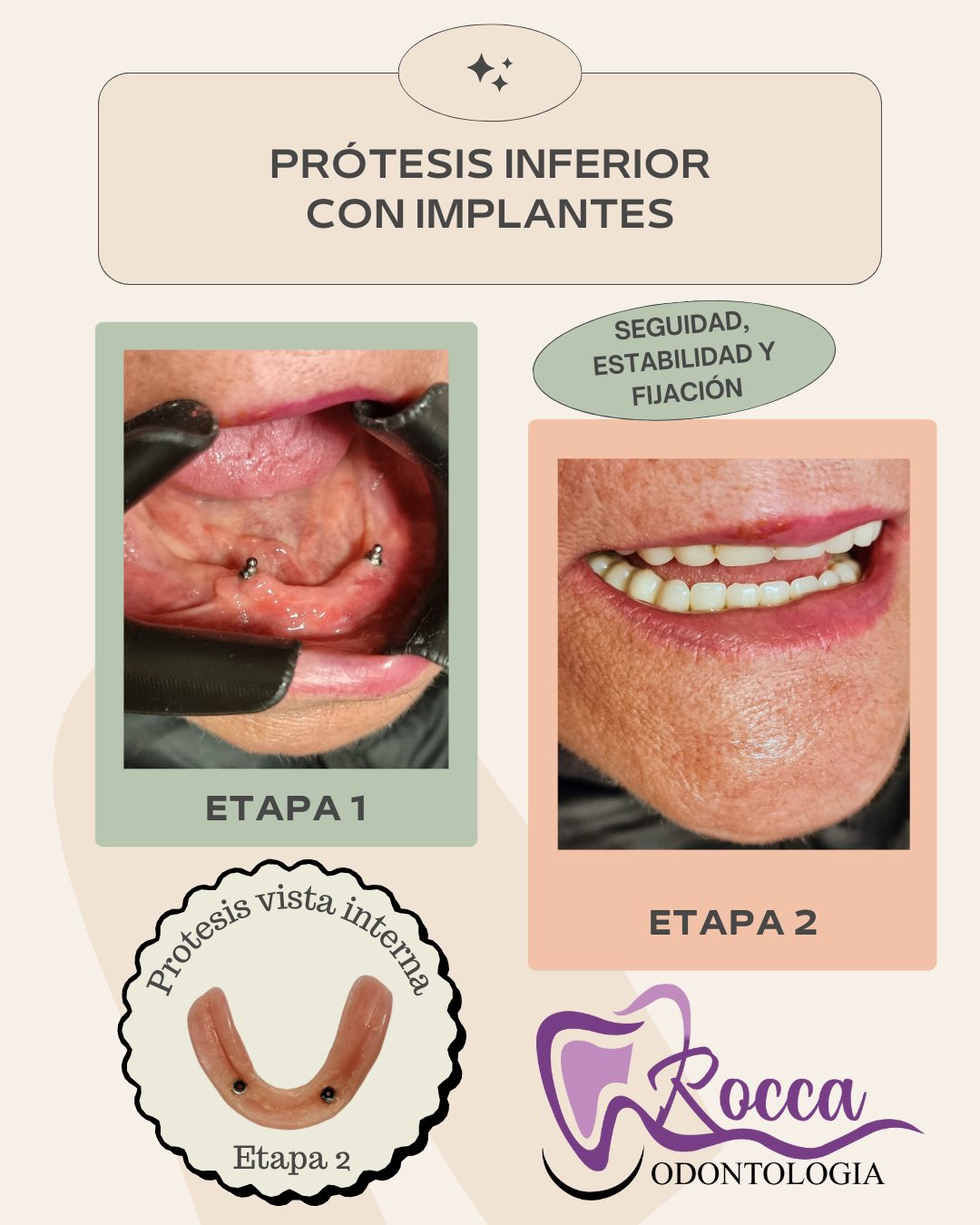 ‼️PROTESIS... - Odontología María Laura Rocca