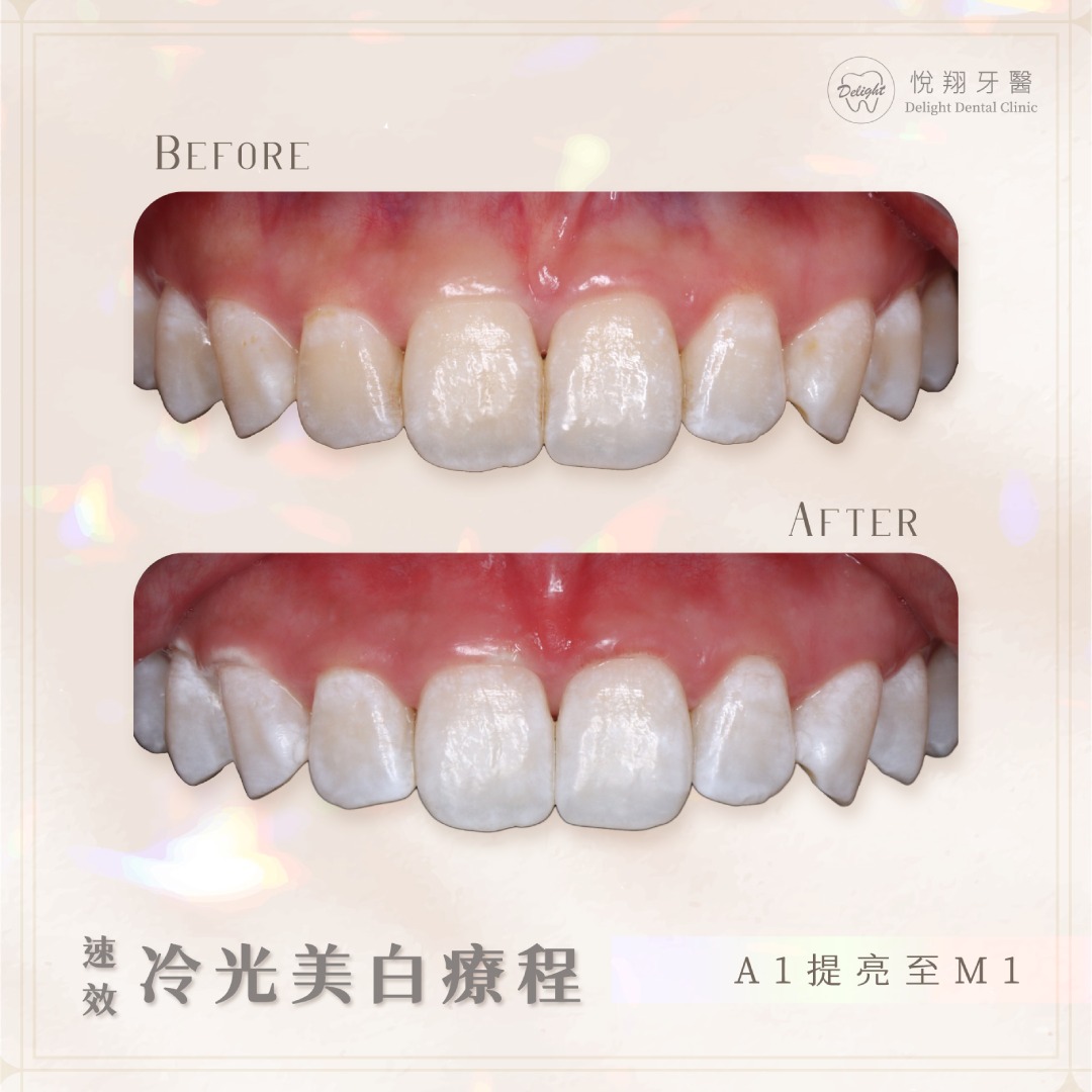 牙齒美白案例．冷光美白 曾經為了一口黃牙而費盡心思嗎 ... - 桃園隱適美 / 悅翔牙醫診所/美學矯正植牙專科 | Facebook