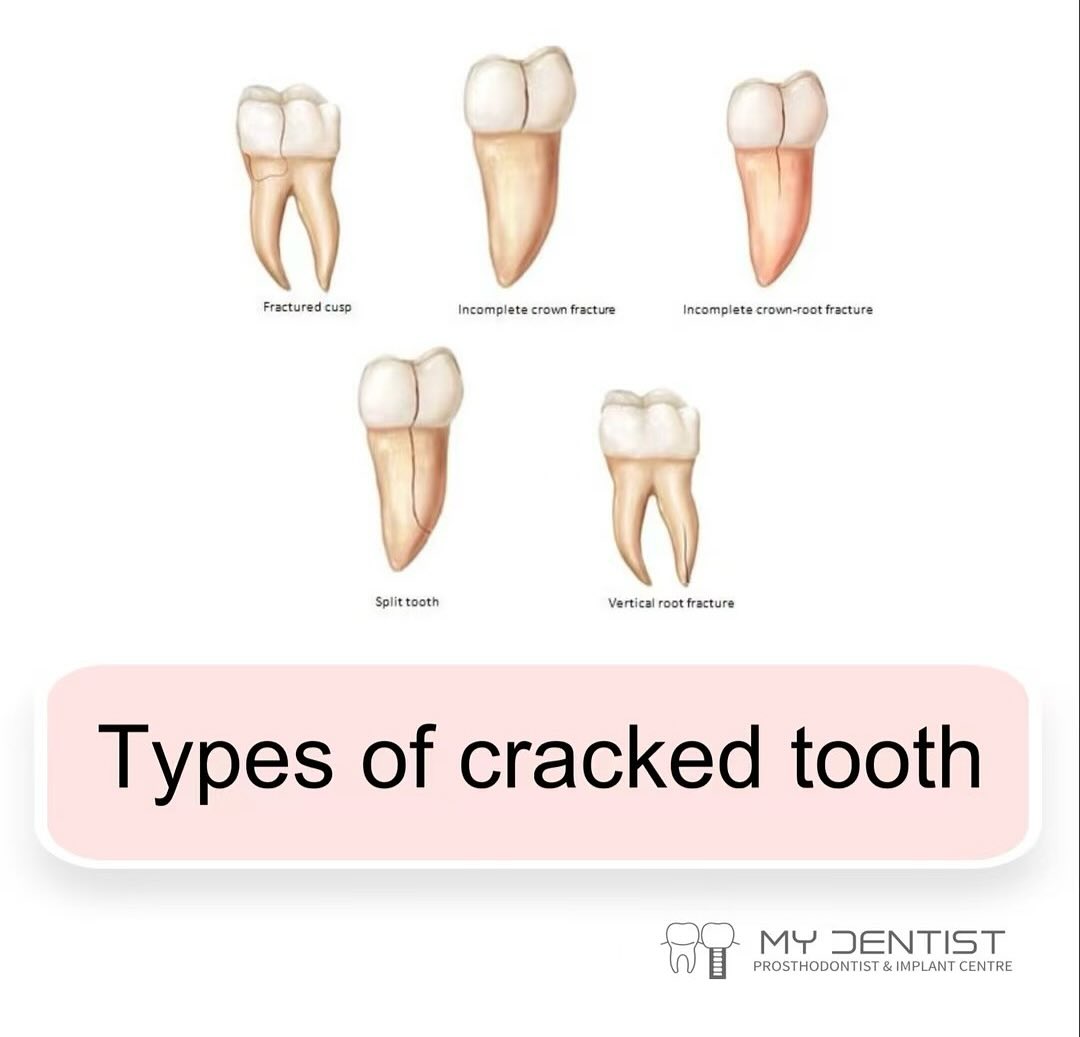 🦷 Not all tooth cracks... - TAK International Dental Clinic | Facebook