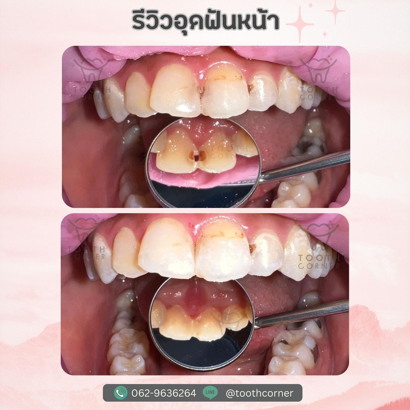 📣📣รีวิวเคส... - Tooth Corner Clinic - ทูธคอร์เนอะ สหคลินิก | Facebook