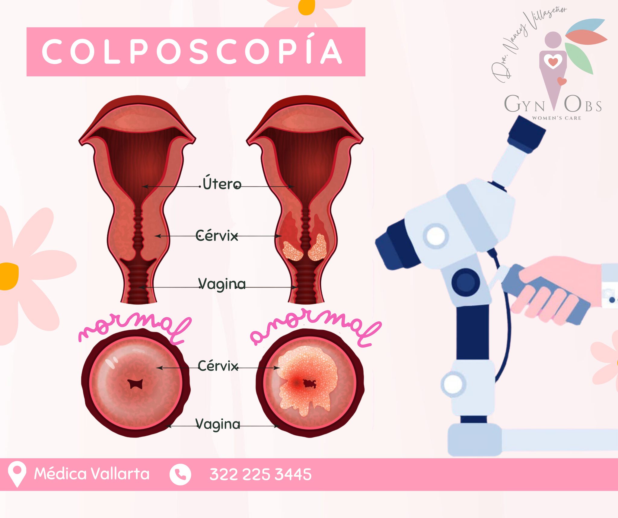🔍 ¿Qué es la colposcopia?... - Dra. Nancy Villaseñor / GynObs | Facebook