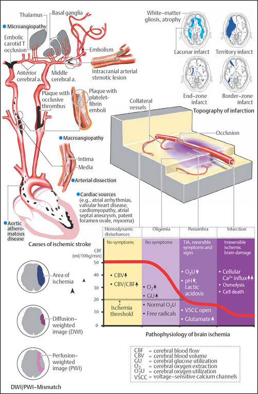 Ramsey - 🧠 Topography of Infarction (§) Territory infarcts are limited ...