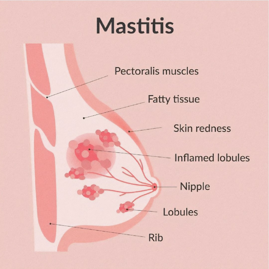 Himanshu - 💗 “Breast health matters — listen when your body speaks.” 🩺🌸 ...