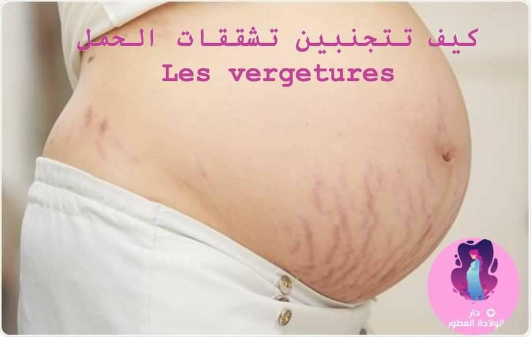 دار الولادة ومصحة التيسير تعاني 50 من النساء الحوامل من مشكلة تمدد الجلد التي تشكل لهن الإحراج و الخجل هذه التشققات هي عبارة عن خطوط حمراء أو بنفسجية تظهر ابتداءا من