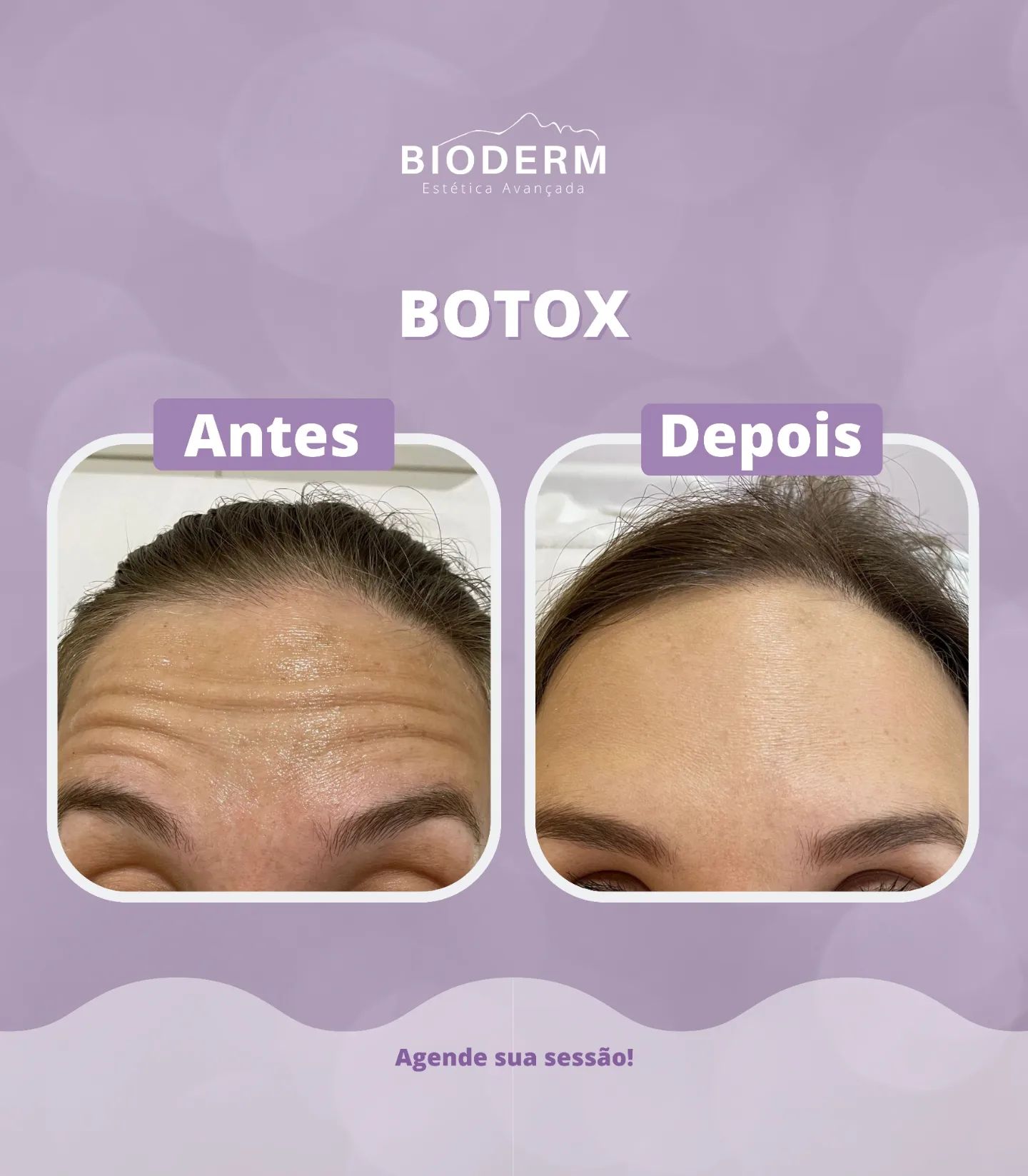 😍 Botox e seus resultados... - Dra. Micheli Ribeiro CRBM 2818