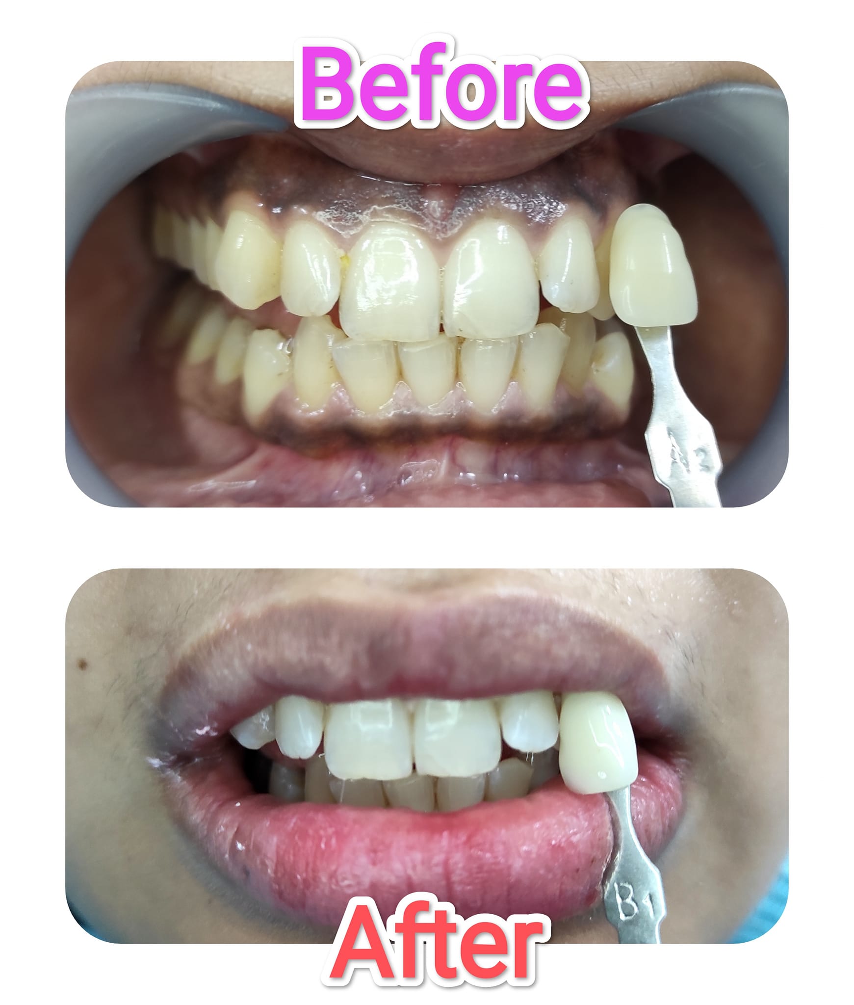 Sigma - Tooth Whitening. Office Bleaching. Single Visit. Before Shade ...