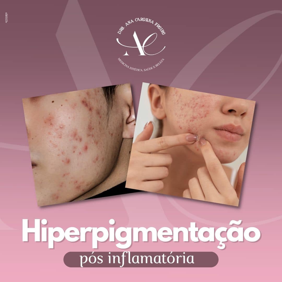 Dra. - A pele oleosa é resultado da alta produção de sebo pelas ...