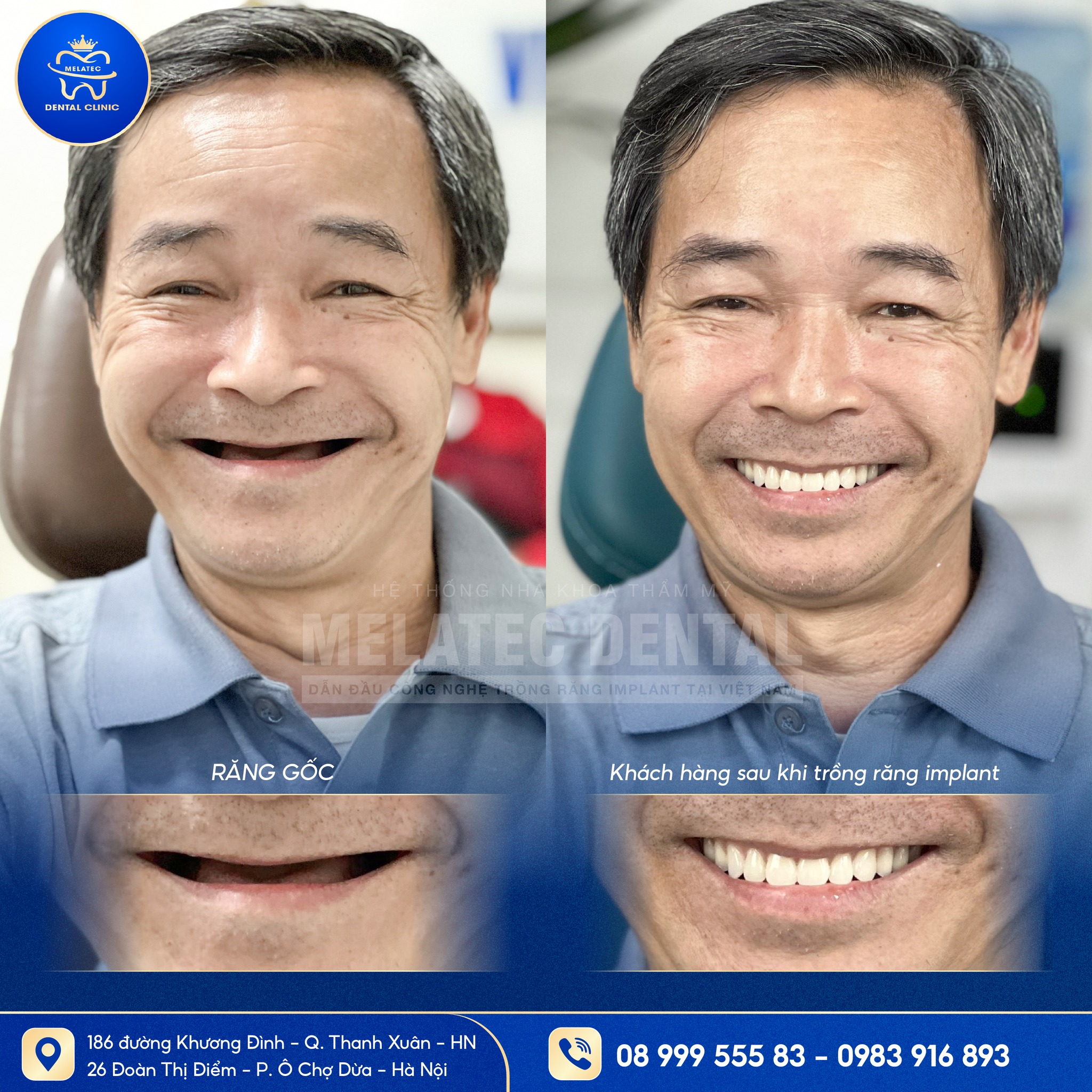 📌 ƯU ĐÃI... - Viện Cấy Ghép Khoa Răng Hàm Mặt Melatec Hà nội | Facebook