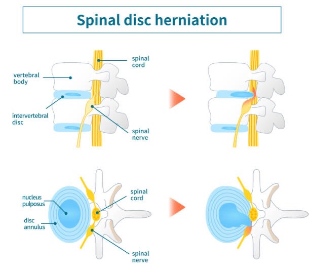 Sports - 🦴Anatomy of a Lumbar Disc Herniation 🦴 The lumbar spine (L1–L5 ...