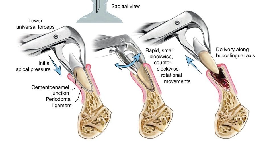 Nesma - Extraction movement for lower incisor tooth | Facebook