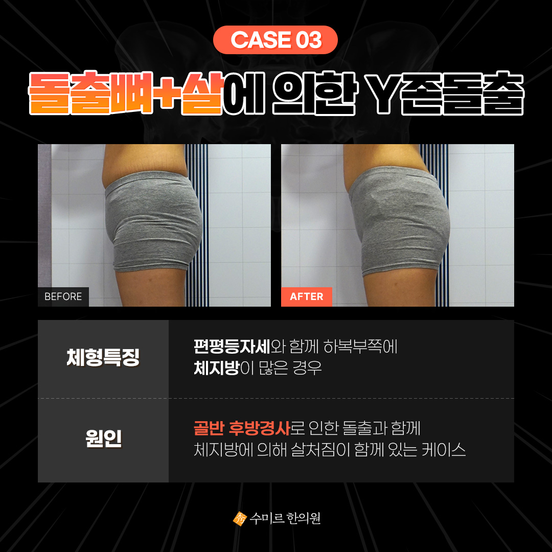 골반미녀 - Y존돌출, 치골돌출, 치구돌출 등등 많은 이름으로 불리는 민망한 Y존 돌출유전이 아닙니다.... | Facebook