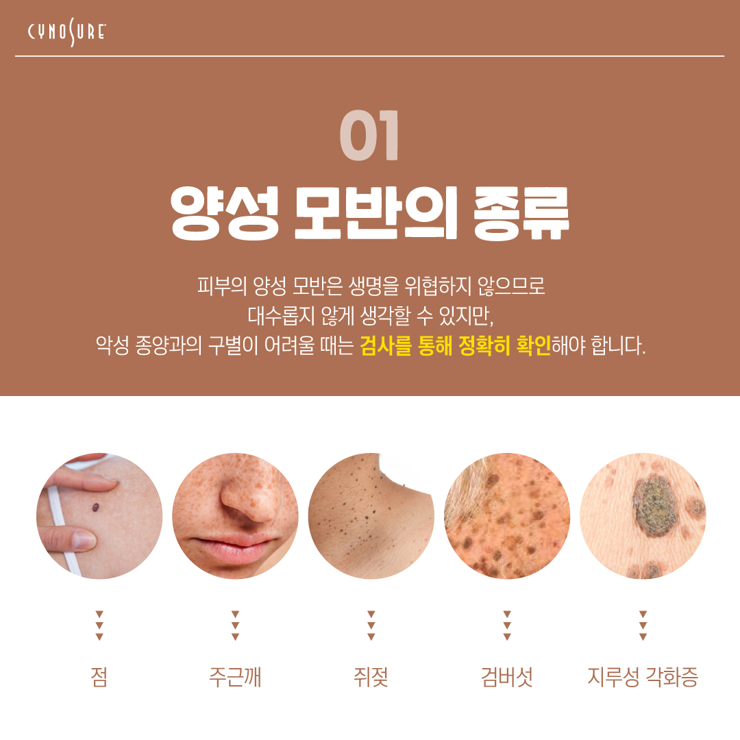 Cynosure Korea - 흔히 볼 수 있는 피부의 점!🤔 양성모반은 생명을 위협하지 않으므로... | Facebook