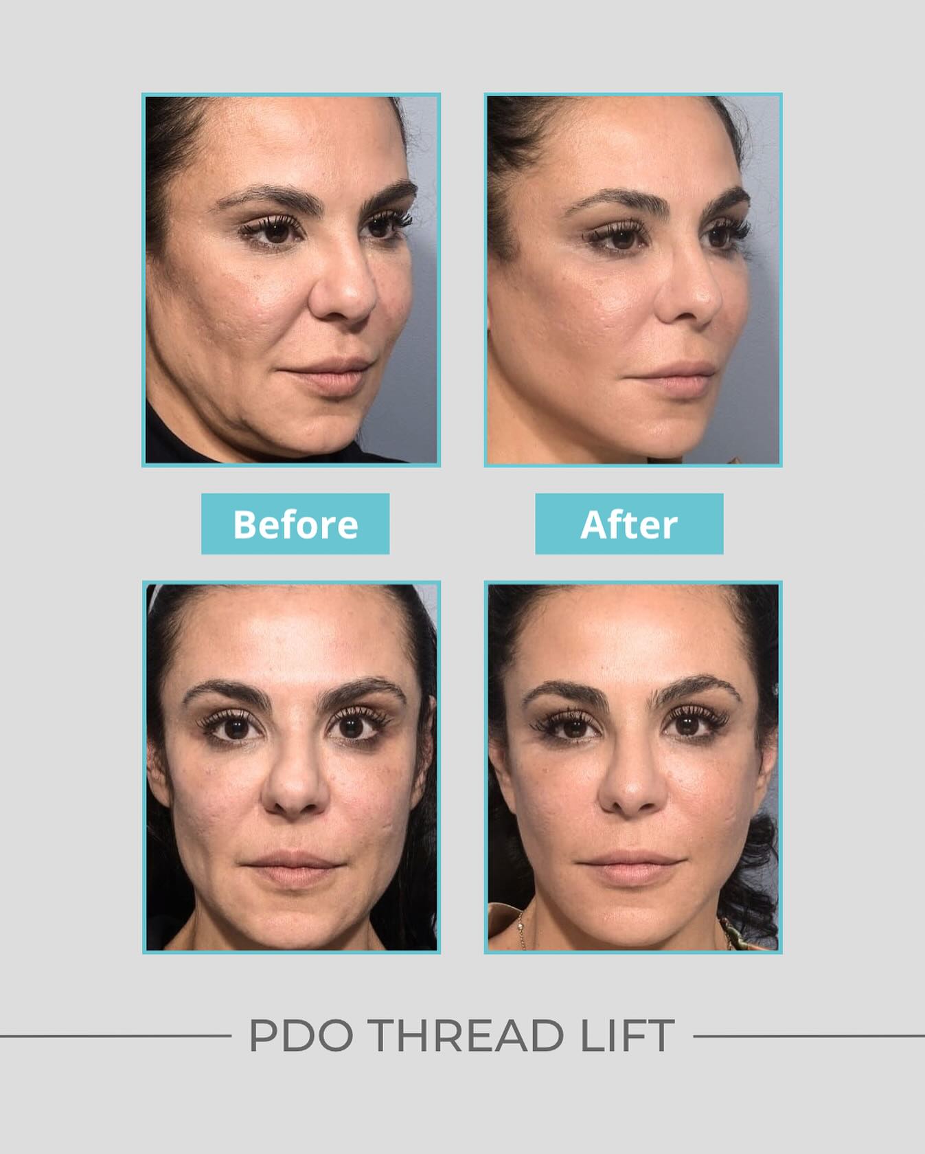 Aesthetemed - PDO Thread Lift is a technique for delicate lifting of ...