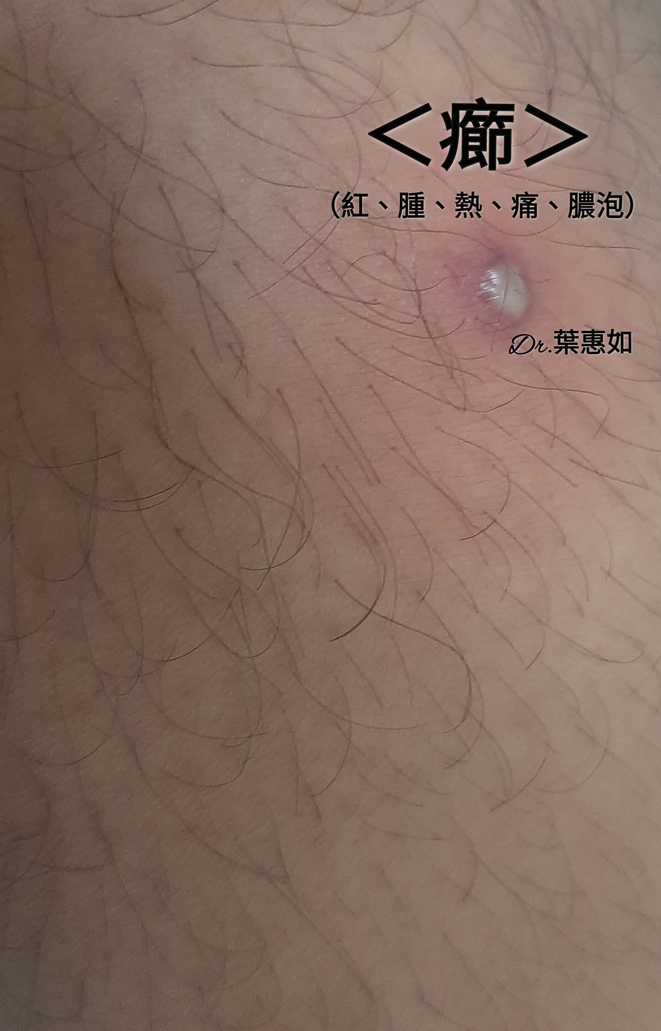 葉惠如醫師 皮膚心靈 - ⚠️ #癤，一種 #細菌 #感染， 🎈產生紅、腫、熱、痛、化膿，好發在 #毛孔 及...