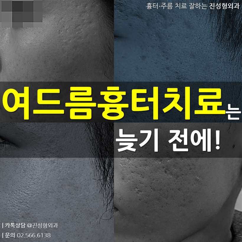진성형외과 자가진피재생술 - 여드름흉터, 더 이상 방치되어서는 안됩니다! 최적의 시기를 놓치면 치료하기가... | Facebook