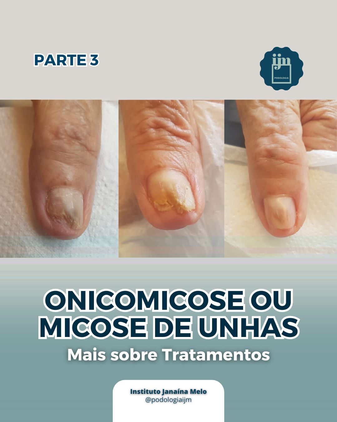 instituto-parte-3-onicomicose-explorando-op-es-de-tratamento