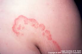 Tiña inguinal (tinea... - Dr. Mario Maldonado Ramírez