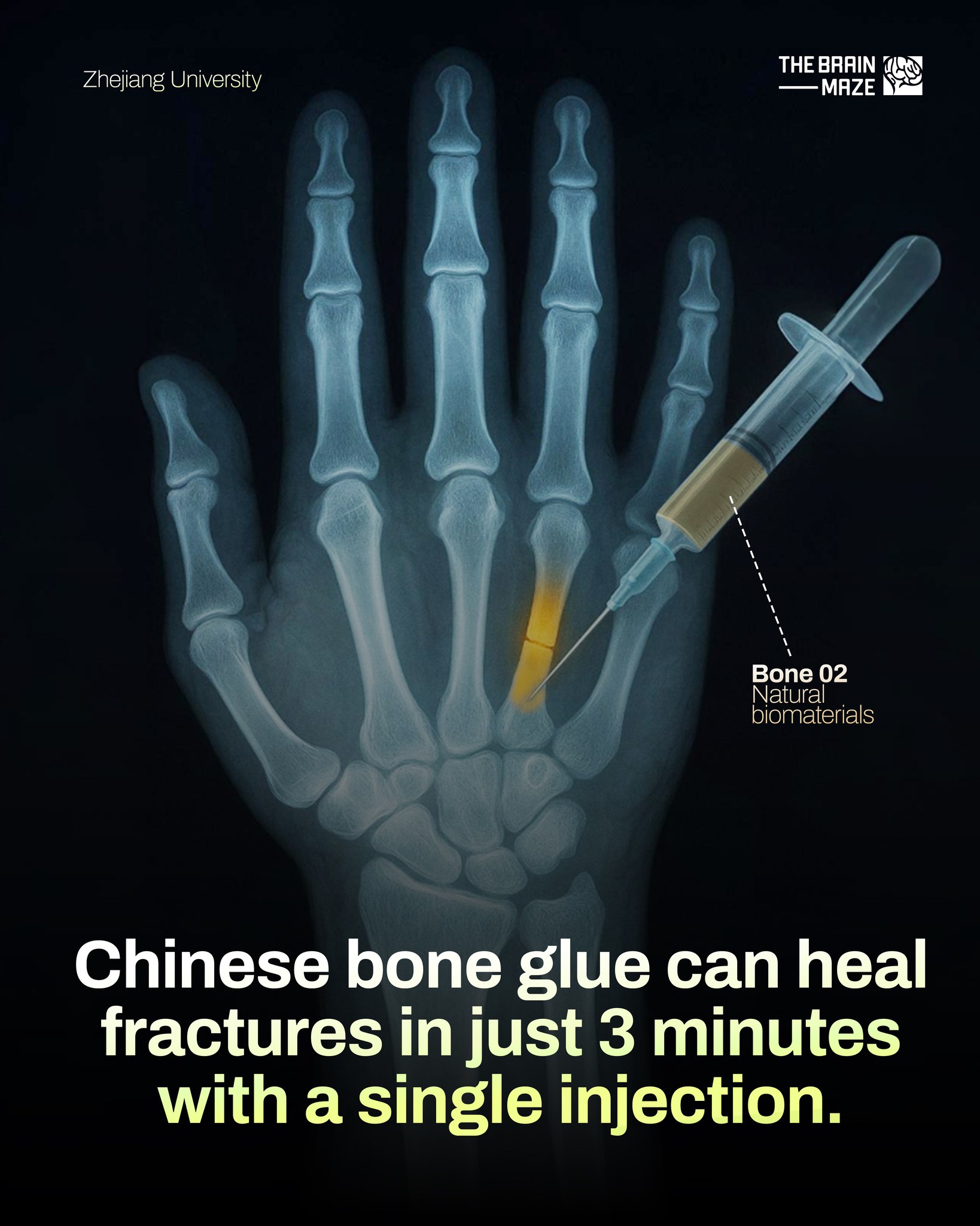 The Brain - Chinese scientists have developed a new bone glue that can ...
