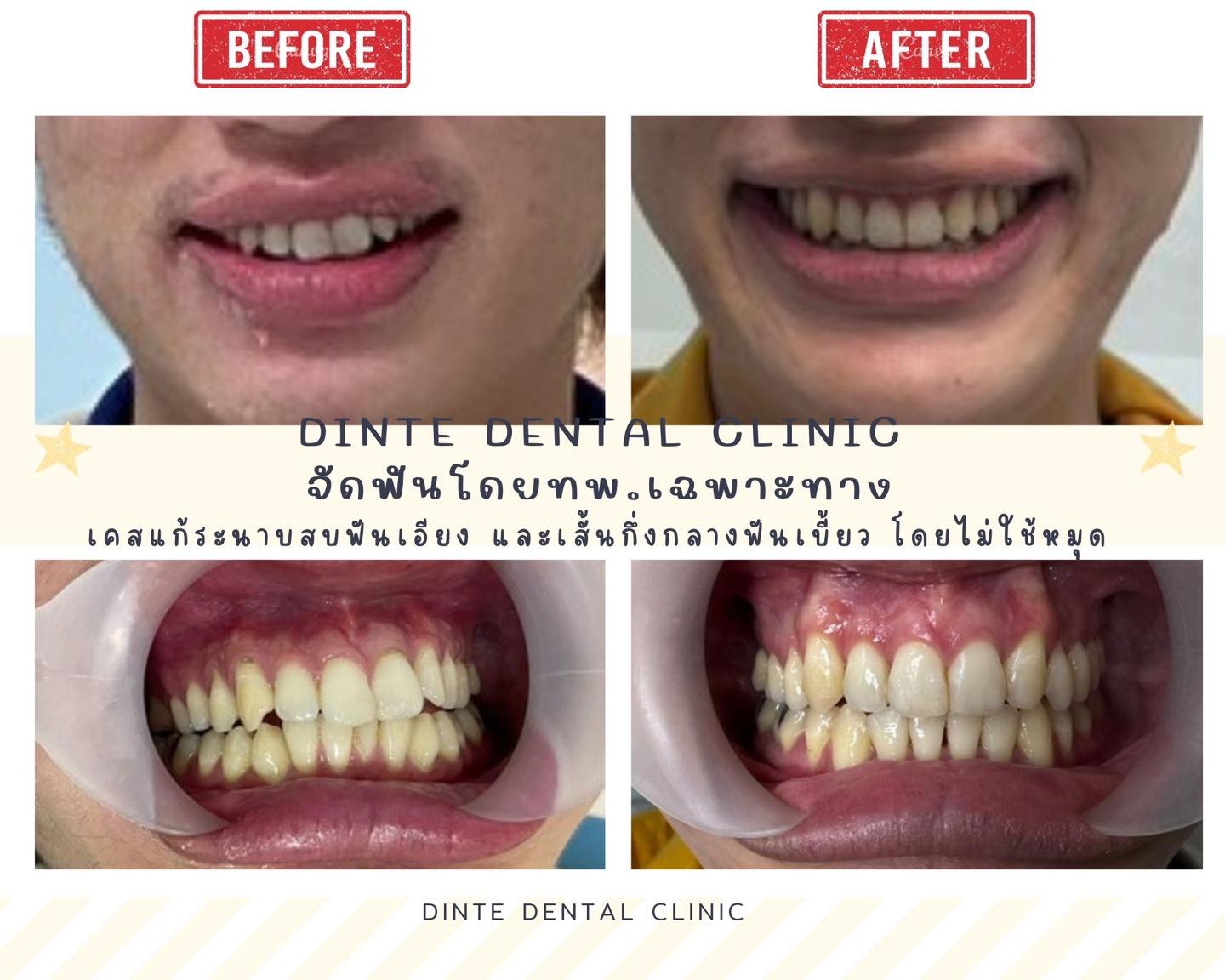 เคสนี้รู้สึกว่ายิมแล้ว เบี้ยว เส้นกึ่งกชางฟันไม่ตรง และสบเปิด คุณหมอจึง ...