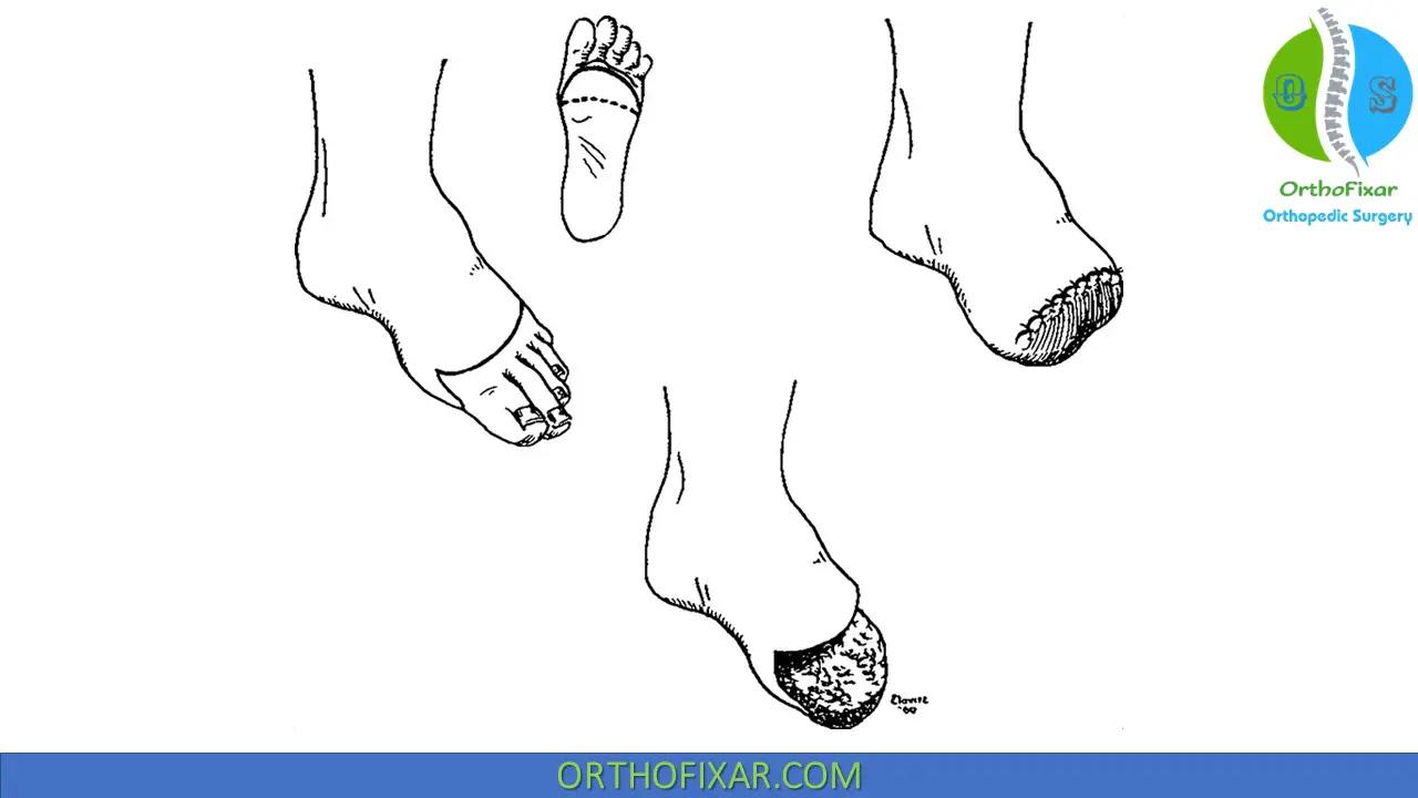 Foot Transmetatarsal... - OrthoFixar - Orthopedic Surgery