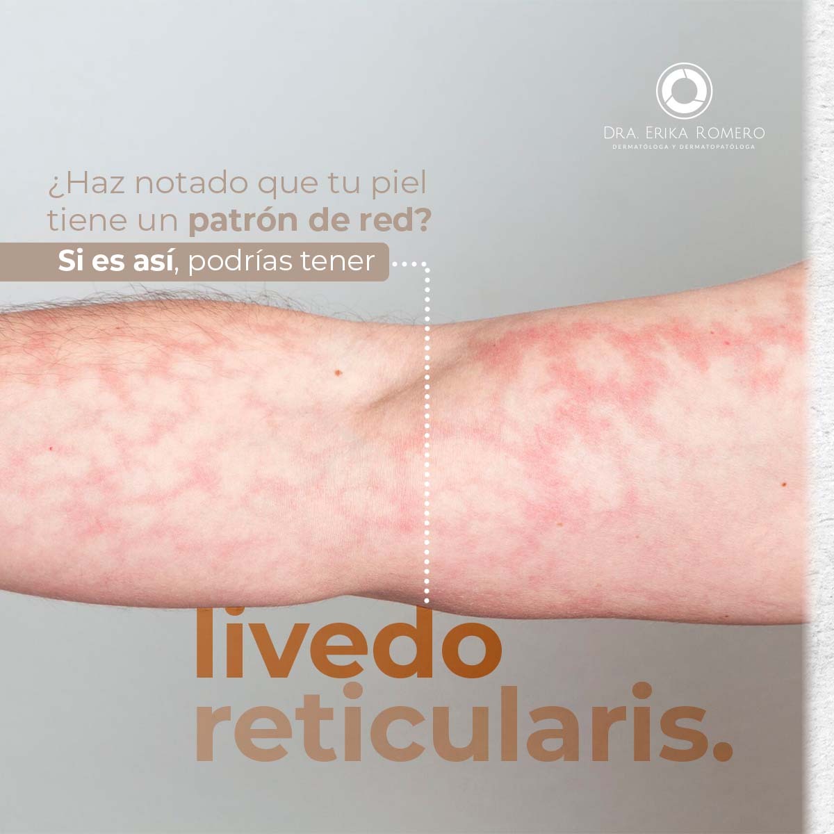 ¿Qué es el livedo reticularis (LR)? 😃... - Dra. Erika Romero