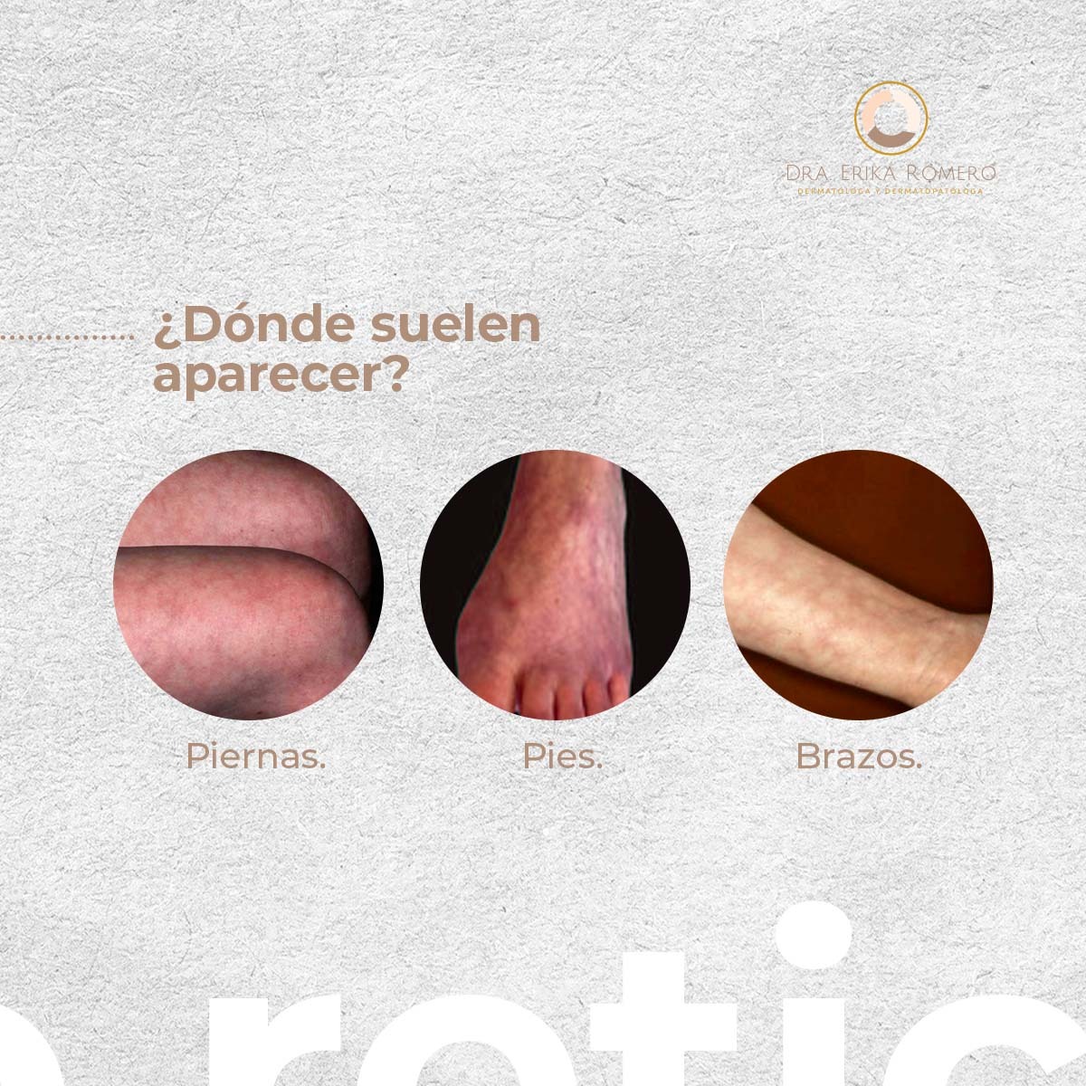 ¿Qué es el livedo reticularis (LR)? 😃... - Dra. Erika Romero