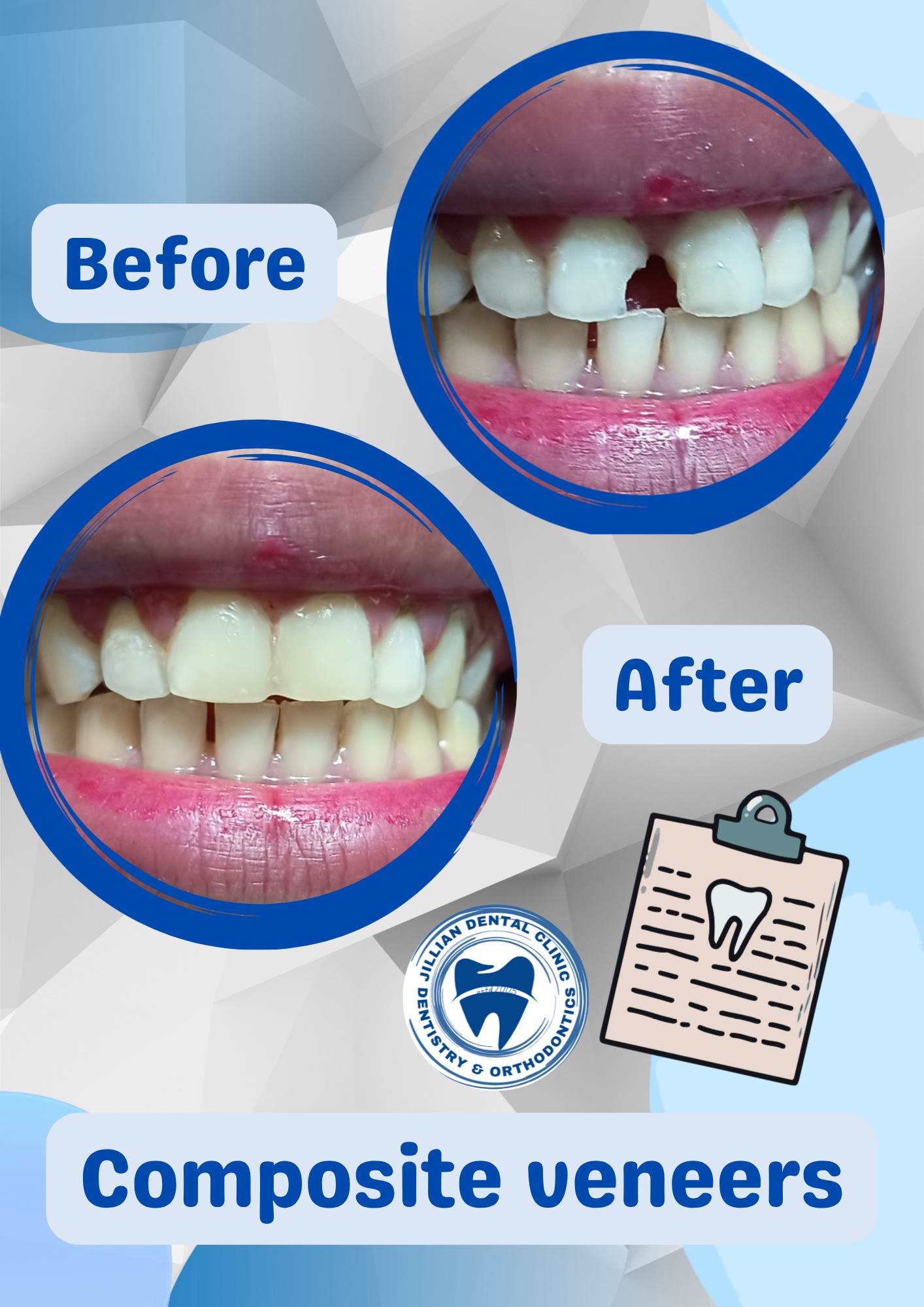 Jillian - COMPOSITE VENEERS -are thin shells made of resin material ...