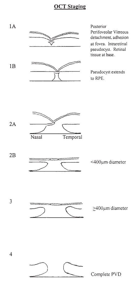 Epiretinal Membrane... - Ophthalmology-Notes And Synopses