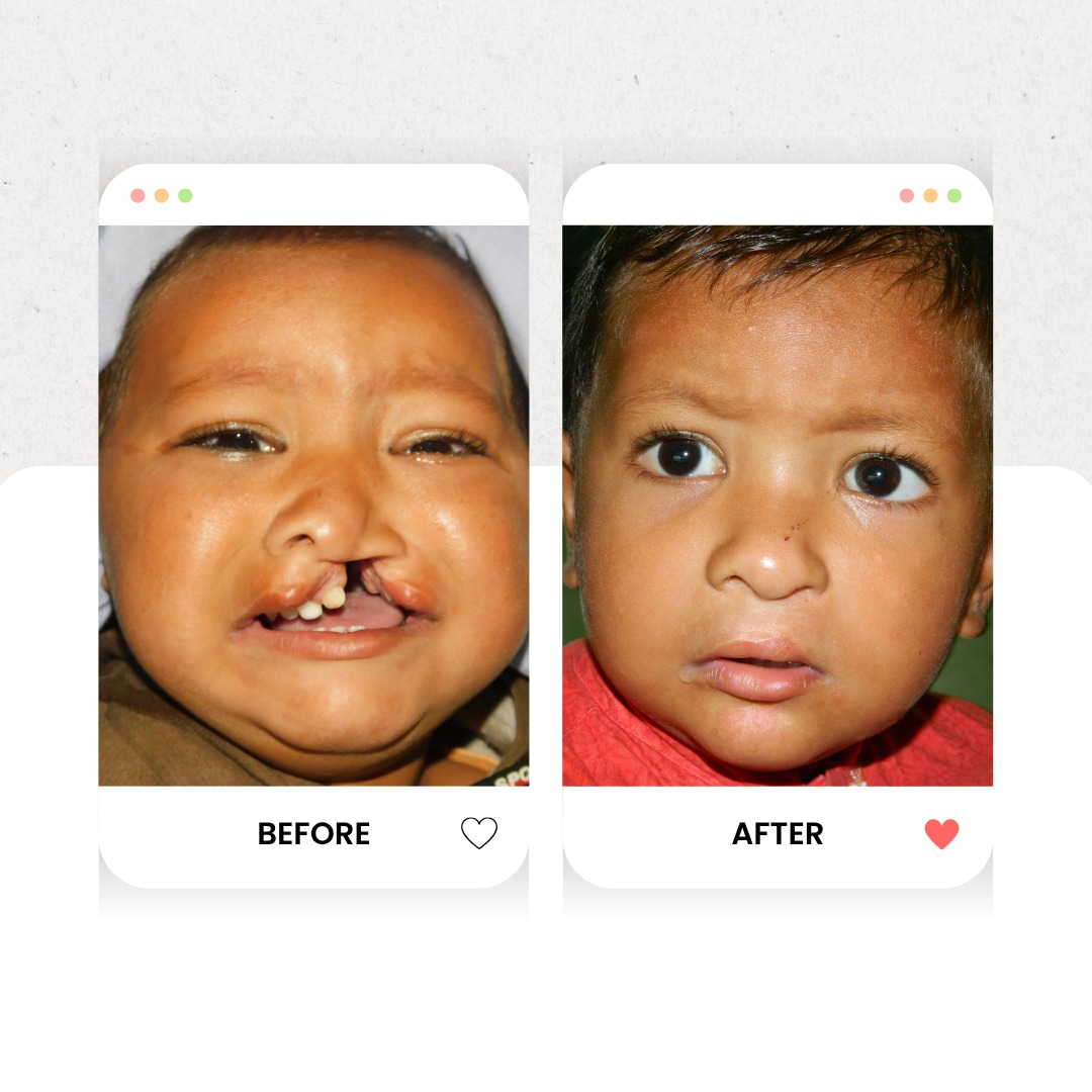 Smile - Free Cleft Lip and Cleft Palate Surgery In Lahore By Dr Irfan ...