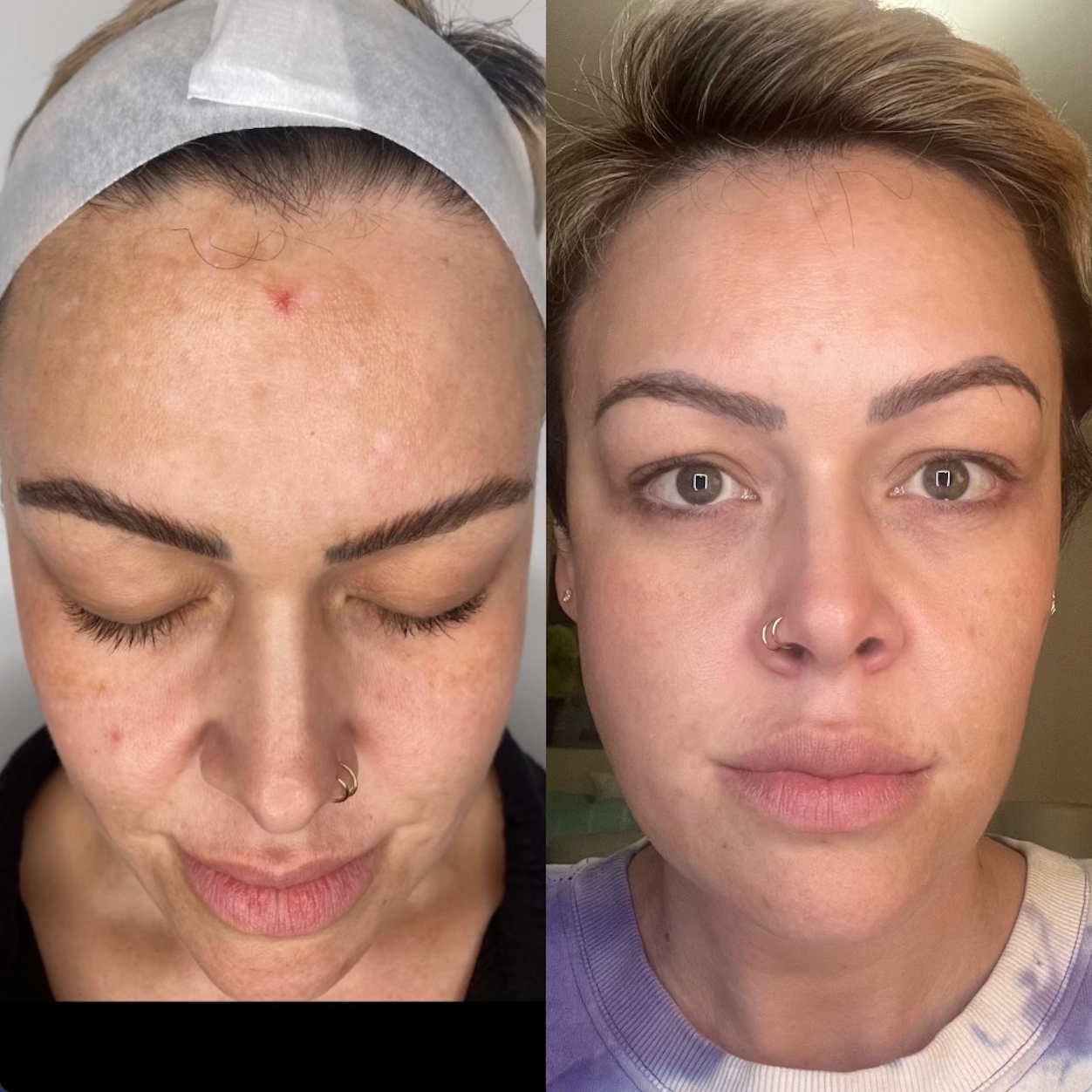 glutathione i m injection for skin whitening Dermashine 600mg Injection, Packaging Type: Box, Our Gluta Drip is gluta comprime serum Pack Size:30 Tablets