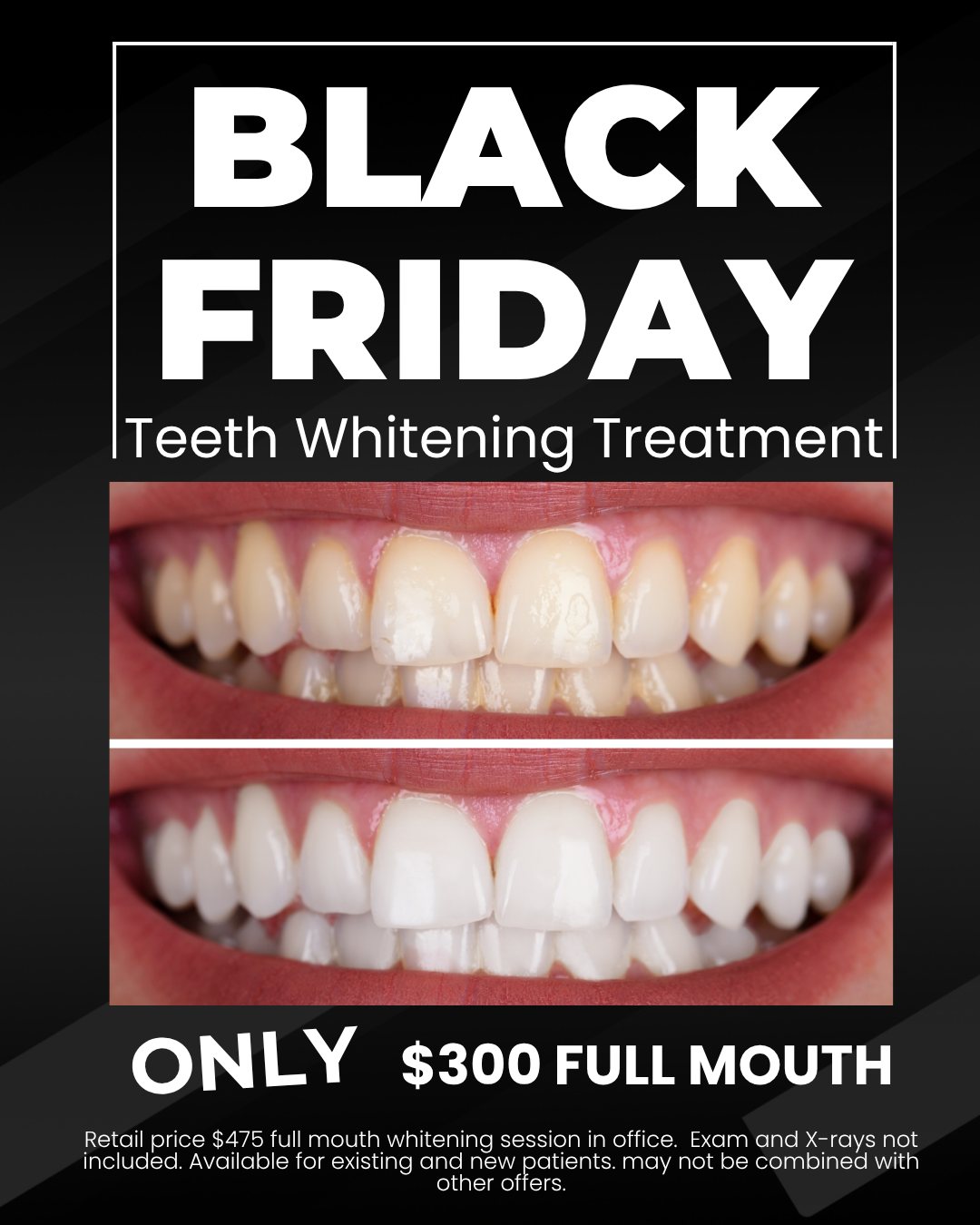 Apollo - Brighten your smile this Black Friday! Get full-mouth teeth ...
