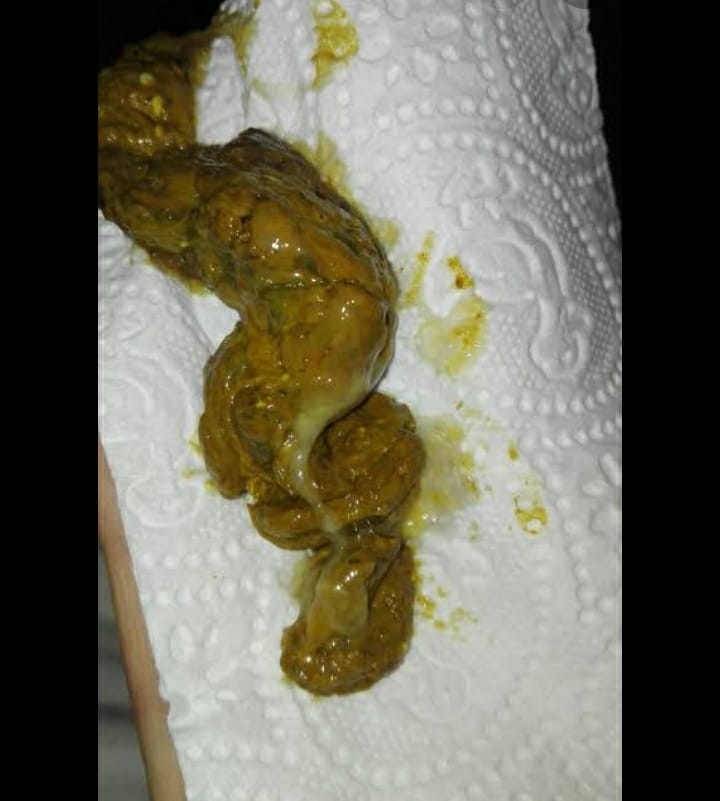 what are the drug used to treat stool with mucus and their dosages?