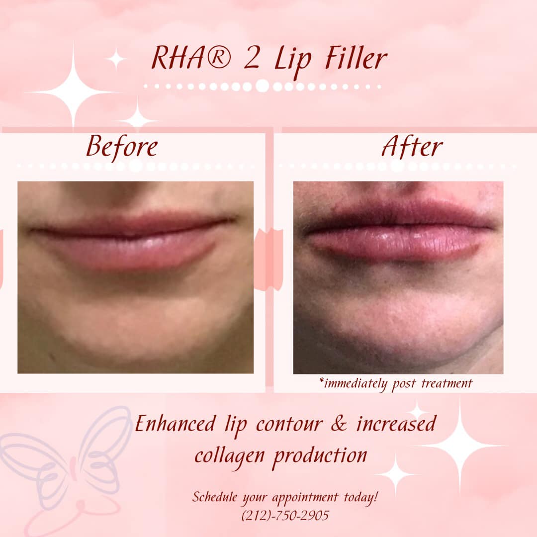 MD Skin Science - ⭐️ Treatment: RHA® 2 RHA® 2 is a...
