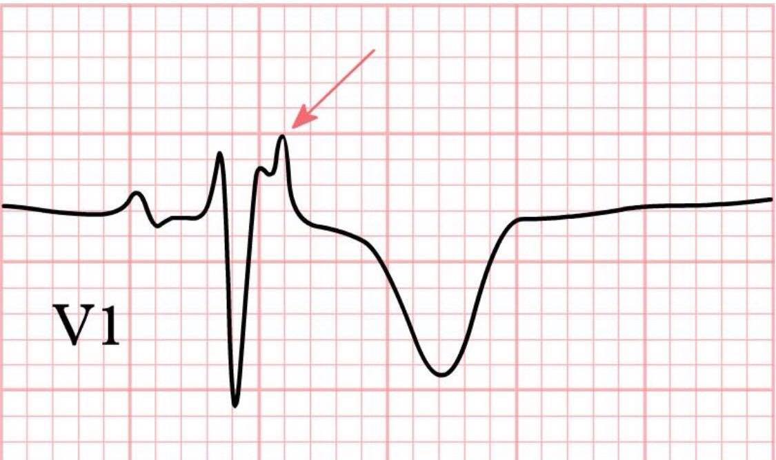 EMNote.org - Epsilon Wave The epsilon wave is a small positive ...