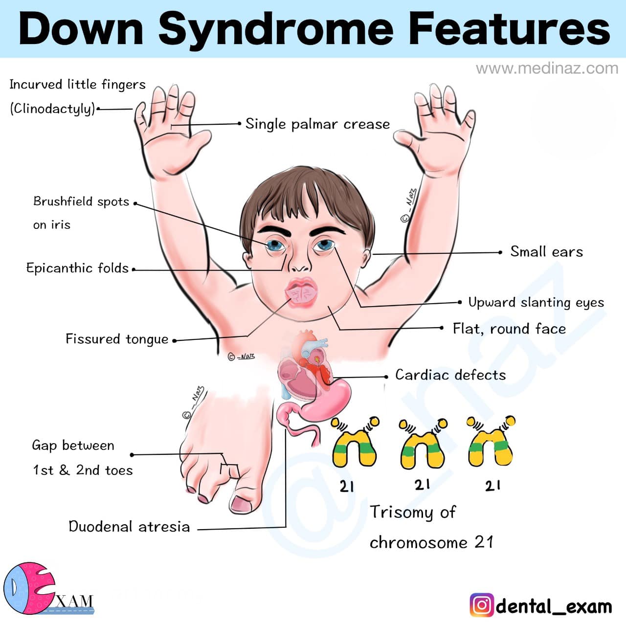 Dental Exam - Down syndrome features