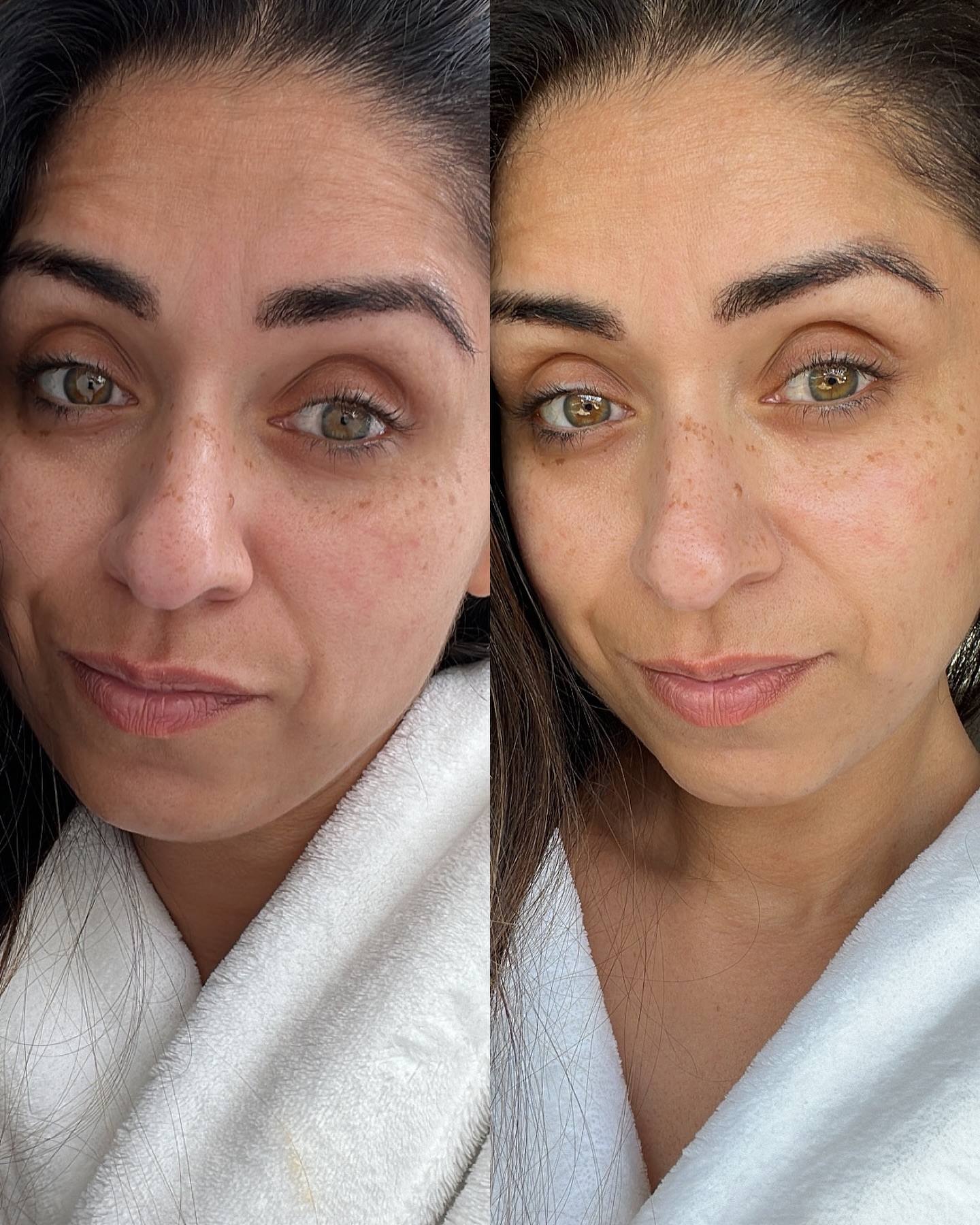 Before or After? Can you spot the difference? 👀 Plot twist: BOTH photos are after using the Belo Essentials Niacinamide Serum 🤭🩵 Now Ya See No Mark, because the #BeloEssentials Niacinamide Serum