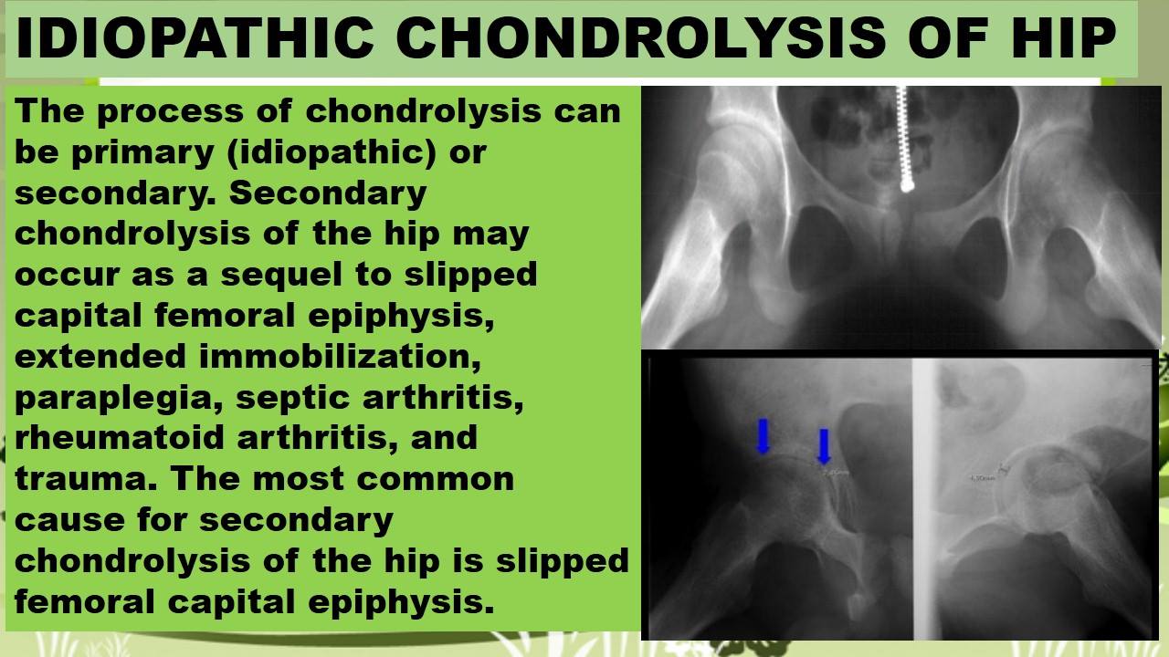 IDIOPATHIC CHONDROLYSIS OF HIP - Radiology Classroom