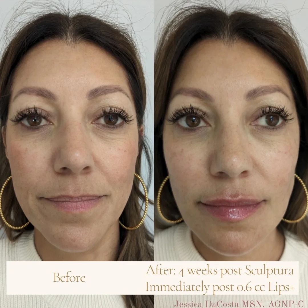 💉 Sculptra and lip filler 💧... - Revive Beauty & Wellness