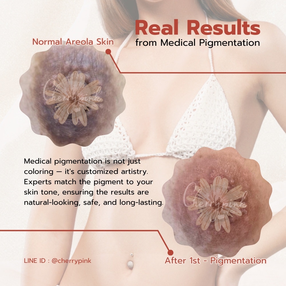 Cherrypink - 🍒 Pink Areola Pigmentation by Dr.jang 📍Book your session ...