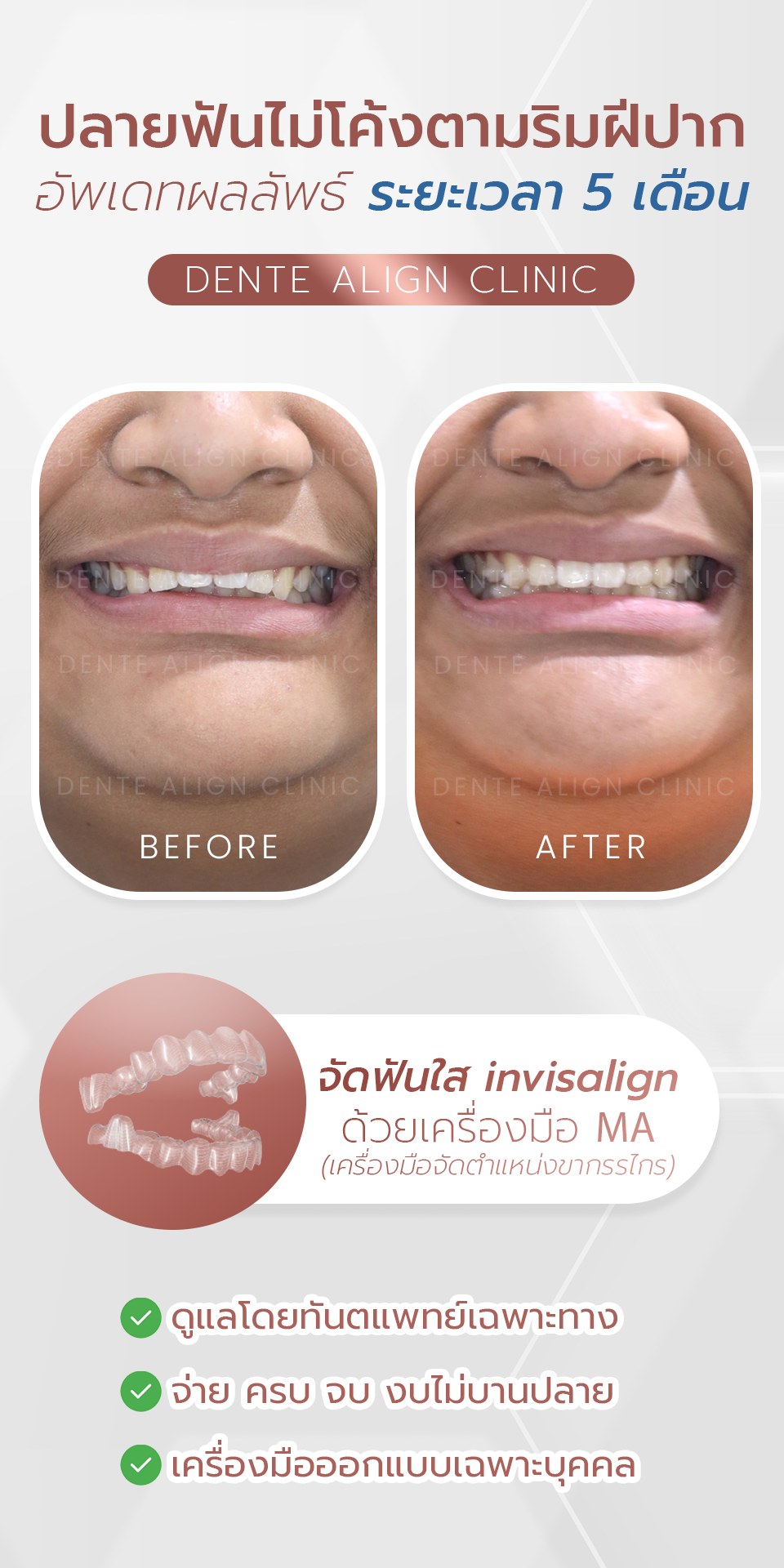 สบายกว่า... - Dente Align Clinic - Invisalign Diamond Provider | Facebook