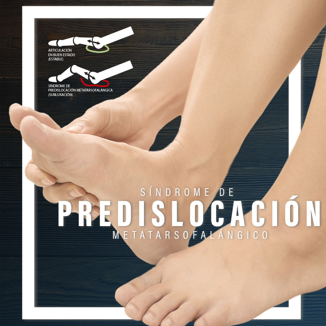Feetpod - 👣¿Sabes qué es el síndrome de predislocación...