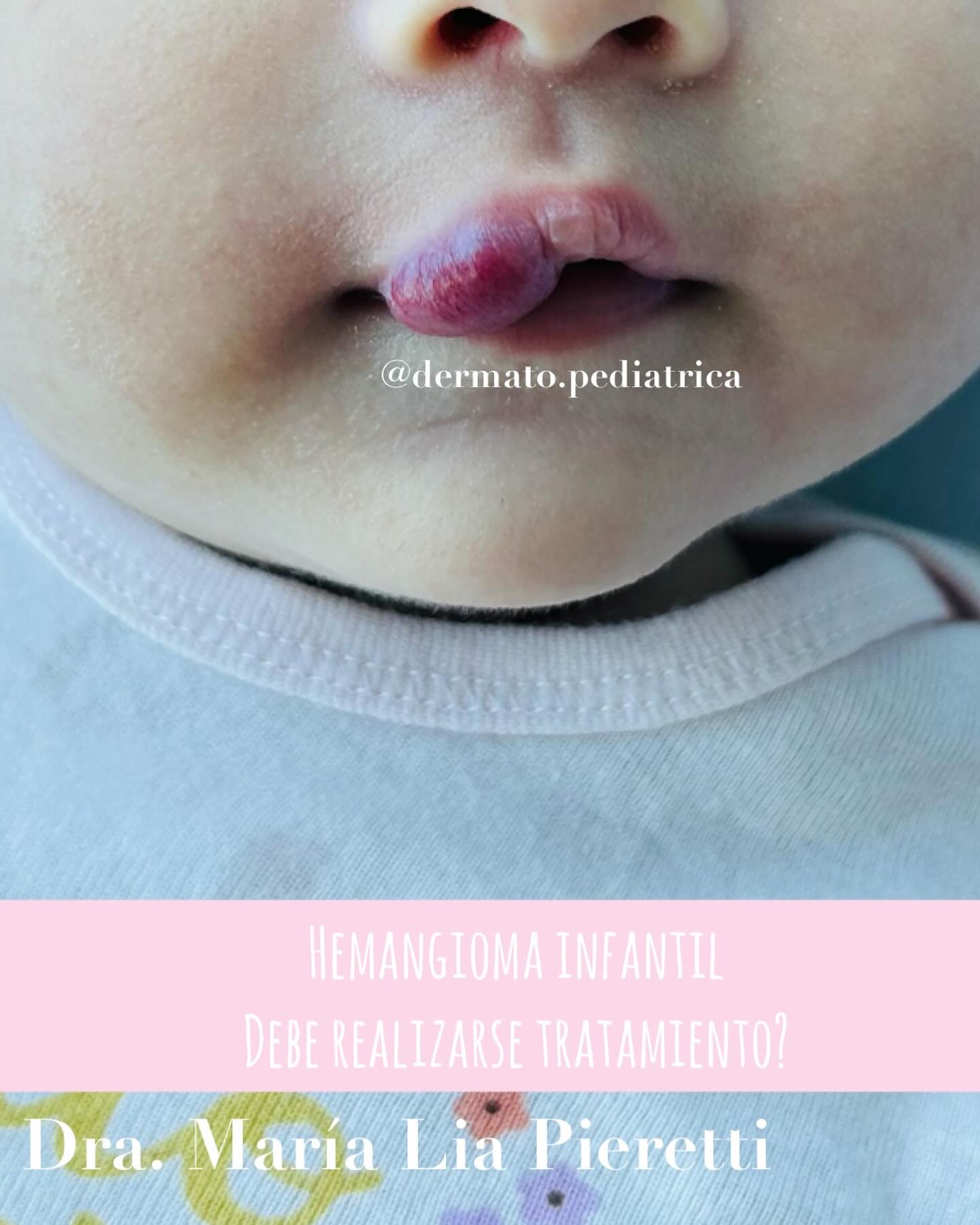 👉Los hemangiomas infantiles... - Dra. Maria Lia Pieretti | Facebook